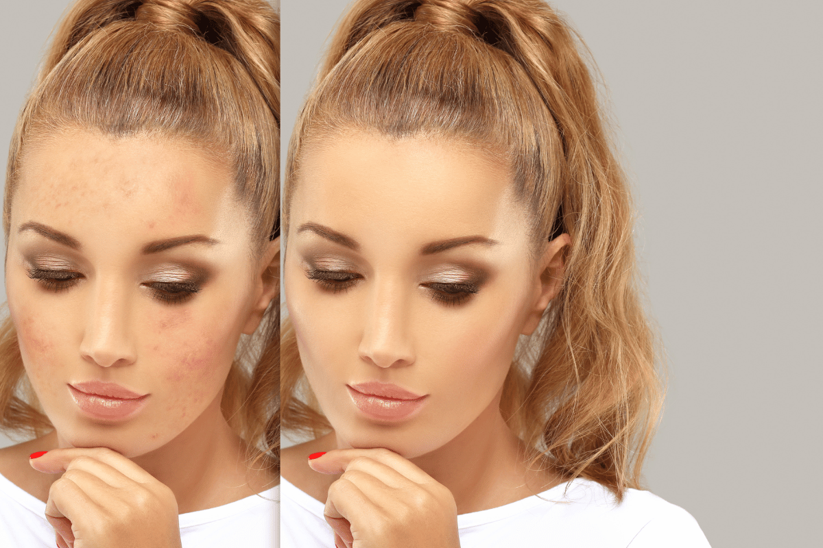 Say Goodbye to Stubborn Acne with Face Serum: 7 Proven Strategies To Reclaim Complexion